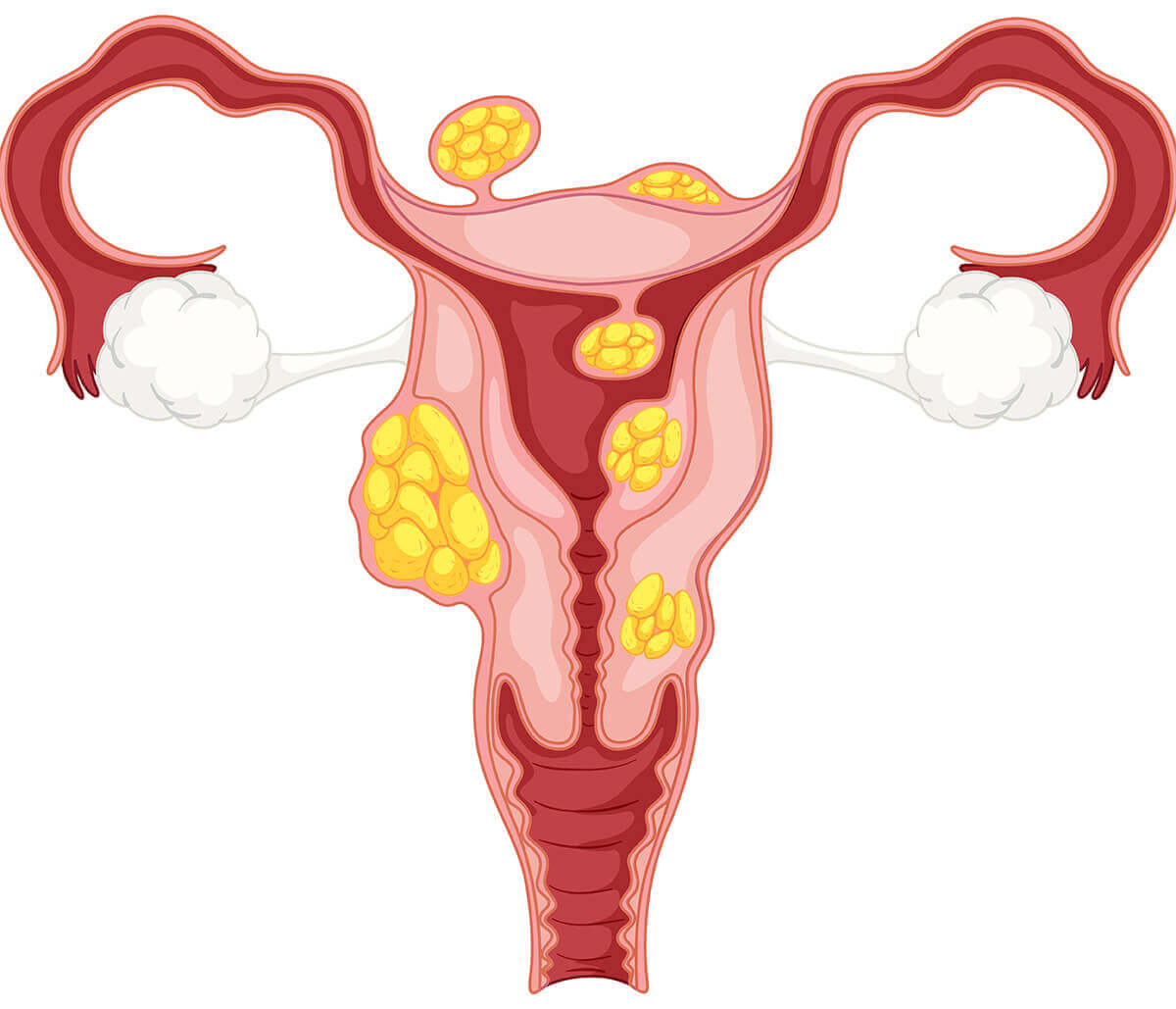 Fibroids at Jenkins Obstetrics, Gynecology and Reproductive Medicine in Cypress Area